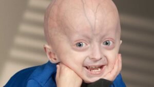 Physical Deformities from Diseases