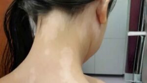 Physical Deformities from Diseases